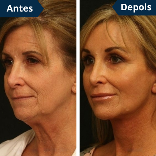 FaceLift PRO Redutor de Papada & Gordura Facial + Creme Aloe Vera de Brinde