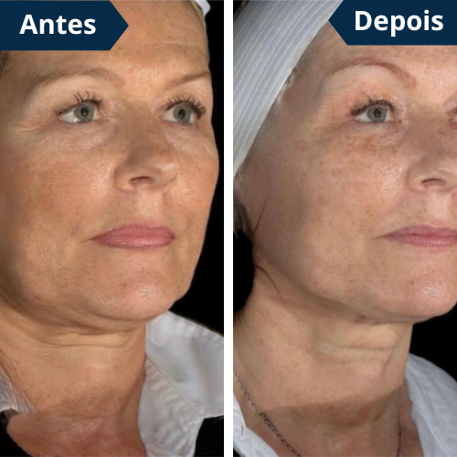 FaceLift PRO Redutor de Papada & Gordura Facial + Creme Aloe Vera de Brinde